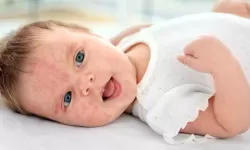 Bebeklerde Alerji Riskleri ve Önleyici Tedbirler Nelerdir? Bebeklerde Alerji Riski ve Önleme Nasıl Yapılır?