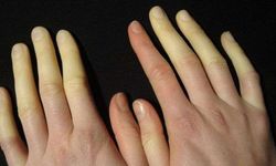 Raynaud fenomeni ne demek? Raynaud fenomeni hastalığı neden olur? Raynaud (reyno) nasıl geçer Raynaud belirtileri