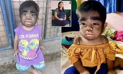 Dünya'nın En Kıllı Bebeği İki Yaşında: Nadir Bir Tıbbi Anomali Olayı