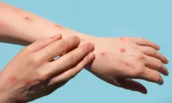 Mpox virüsü nedir? Maymun çiçeği virüsü belirtileri nelerdir?