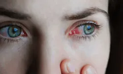 Salgın hastalık alarma geçirdi! Kırmızı Göz hastalığı nedir?