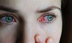 Göz alerjisine dikkat, görme kaybına kadar gidebilir