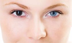 İki gözün farklı renkte olması (Heterokromi) nedir, neden olur?