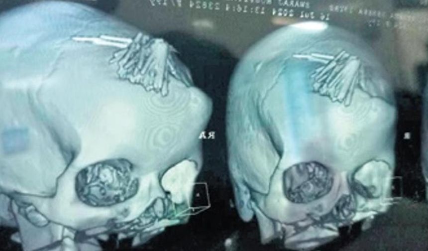 Baş Ağrısı Şikayetiyle Hastaneye Gitti, Kafasında 77 İğne Çıkartıldı